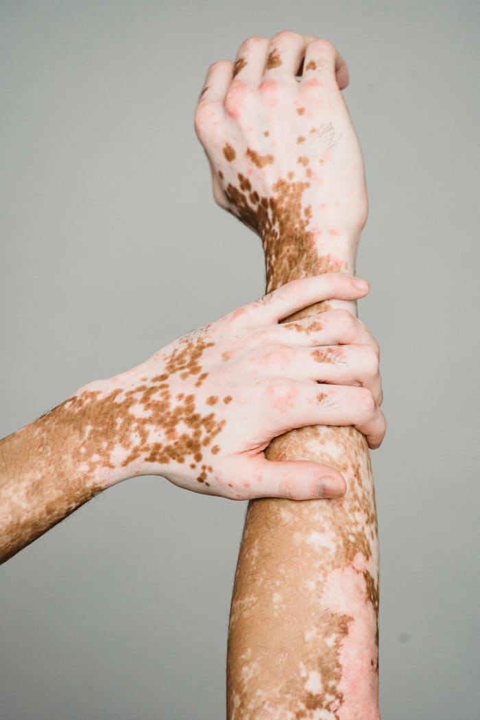 Detailed view of hands showing skin condition, highlighting unique patterns.