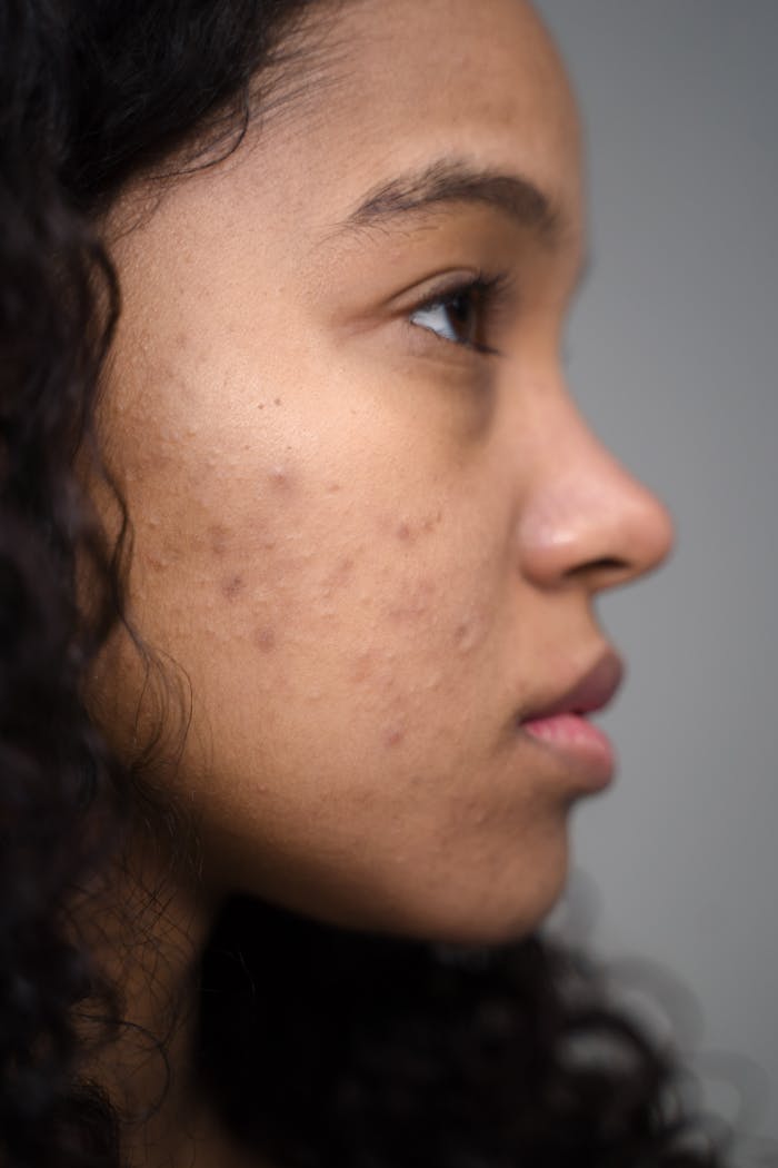 Close-up side profile of a woman showing natural skin with acne.